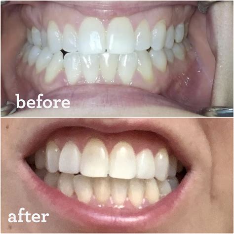 invisalign crossbite before and after.